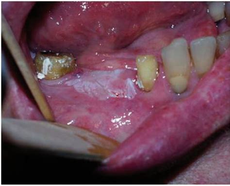 Oral Leucoplakia Of The Gums Before The Surgical Treatment