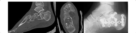 Pathological Fracture Due To A Simple Calcaneal Bone Cyst In A 16 Year