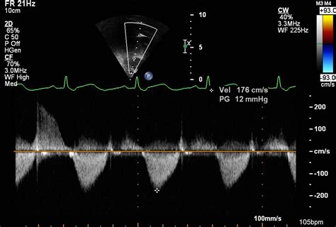Parasternal Long Axis Pulmonary Valve Pediatric Echocardiography