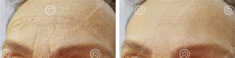 Forehead Women Wrinkles Before And After Procedures Stock Image Image