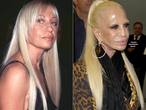 60 Worst Cases Of Celebrity Plastic Surgery Gone Wrong