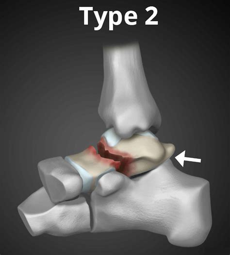 Fracture Of Talus