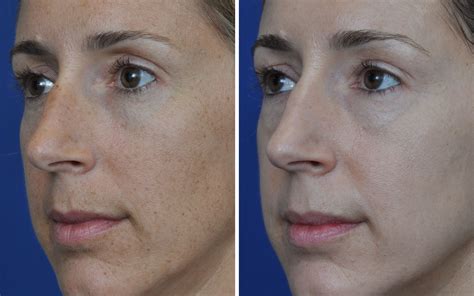 Annapolis Bbl Photofacial Before And After Annapolis Plastic Surgery