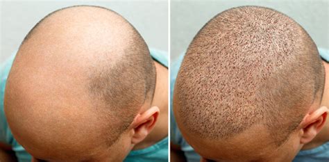 Stages Of Growth After A Transplant The Hair Loss Recovery Program