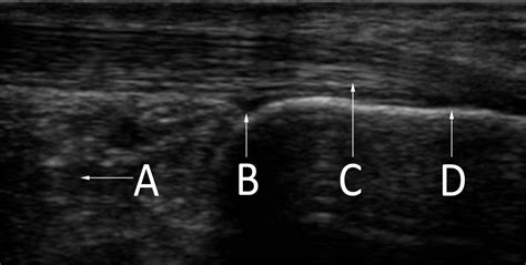 Longitudinal Ultrasound Image Of The Posterior Ankle The Bmj