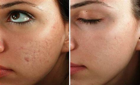 Microneedling Treatment Benefits Costs Results And Procedure Steps