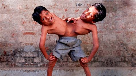 Unusual Conjoined Twins You Wont Believe Exist Youtube