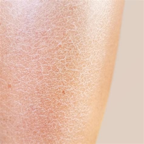 peau sèche sur les jambes que faire eau thermale avène