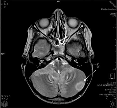 The Mri Image Of The Head Transverse Scan T2 Weighted Image With The