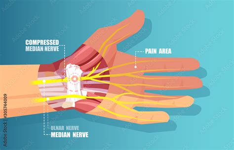 Vector Of A Carpal Tunnel Syndrome With Median Nerve Compression Stock