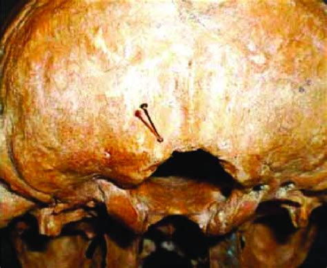Skull With Occipital Emissary Foramen On Left Side N5 64 A Pin
