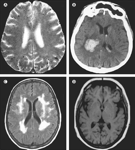 Cerebral Small Vessel Disease From Pathogenesis And Clinical