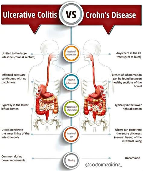 Difference Between Ulcerative Colitis And Crohn S Disease Artofit