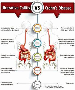 Crohn 39 S Disease Vs Ulcerative Colitis