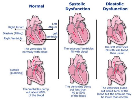 Heart Failure Systolic Vs Diastolic Heart Failure