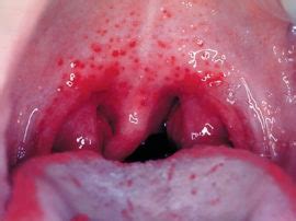 red rash   palate   mouth  adults  children red dots