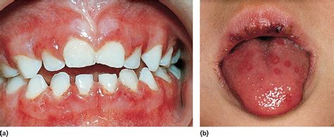 White Bumps On Buccal Mucosa