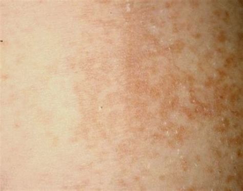 Maculopapular Rash Symptoms Treatment Causes Pictures Hubpages