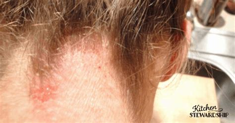Itchy Red Rash On Scalp And Neck Allergy Trigger