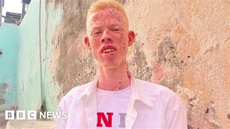 Somalis With Albinism Pelted With Stones And Raw Eggs