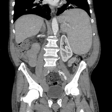 The Ct Scan Of Abdomen And Pelvis Shows Bulky Lymphadenopathy