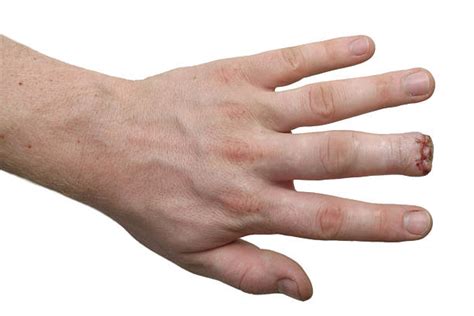 Hand With Missing Fingers Stock Photos Pictures And Royalty Free Images