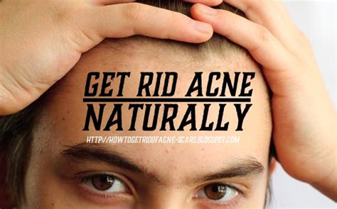 How To Get Rid Of Acne Scars Naturally
