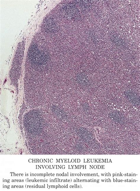 Pathology Outlines Chronic Myelogenous Leukemia