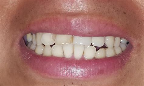 Partial Dentures Gretna La Replacing Missing Teeth