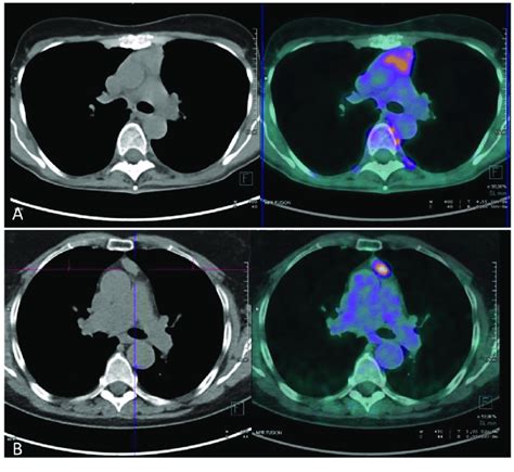 Petct Findings In A Patient With Thymic Hyperplasia A And A