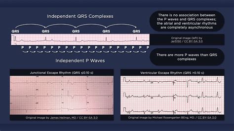 Third Degree Atrioventricular Block Ecg Youtube