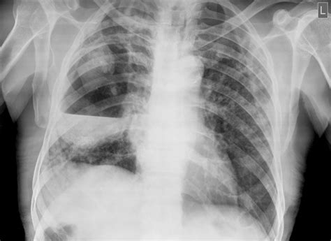 Lung Abscess With Subcutaneous Emphysema Pneumothorax And