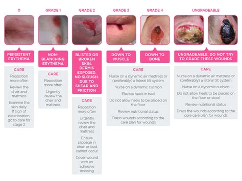Bed Ulcer Grading See More