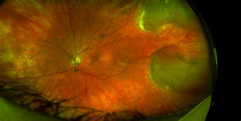 Optomap Retinal Exam Thomas Vision Clinic Of Leesville La