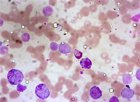 Photomicrograph Of Peripheral Blood Smear Showing Immature Myeloid My