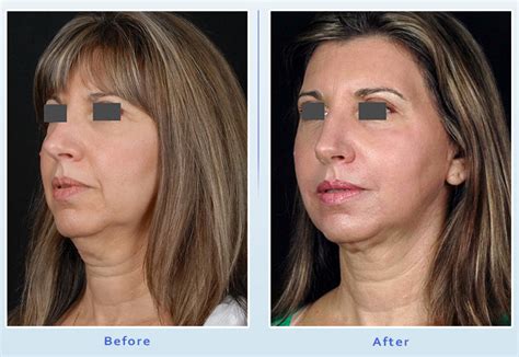 Laser Facelift Beverly Hills Ca Non Surgical Facial Skin Tightening