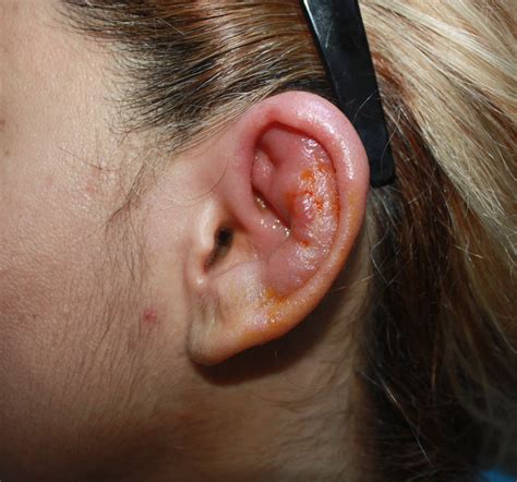 Erythema And Edematous Swelling Of The Left Ear The Inflammation