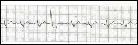 Float Nurse Practice EKG Rhythm Strips 113