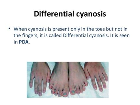 Cyanosis Ppt By Dr Girish Jain