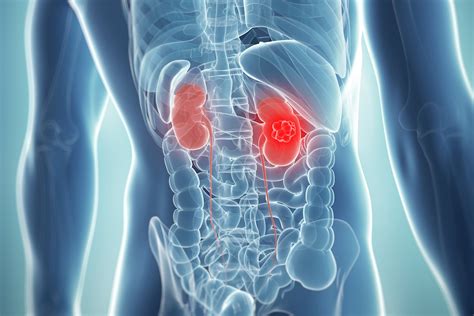 Kidney Cancer Signs Symptoms Causes Treatments