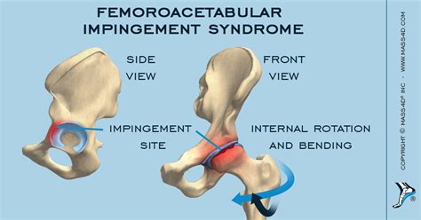 Treating Femoroacetabular Impingement Syndrome Mass4d® Foot Orthotics
