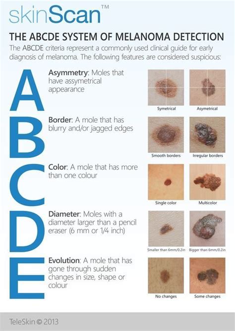 Melanoma Abcde Chart