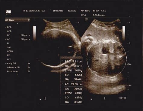 Cara membaca hasil usg (ultrasonografi) banyak yang belum mengetahui. USG foto hasil usg bayi perempuan di bali | wordsof ...