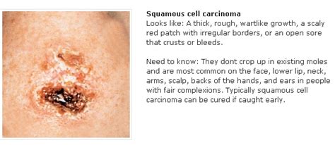 How To Spot Skin Cancer Skin Changes Skin Cancer Advices
