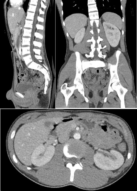 Tomografía computarizada de abdomen y pelvis Computed tomography of
