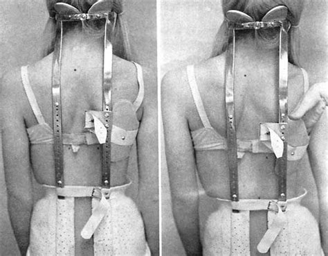 Rear View Of Milwaukee Brace Scoliosis Vintage Medical