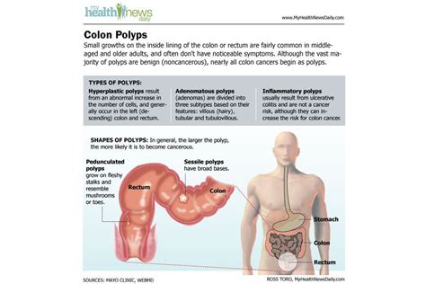 Colon Cancer Causes Symptoms And Treatments Live Science