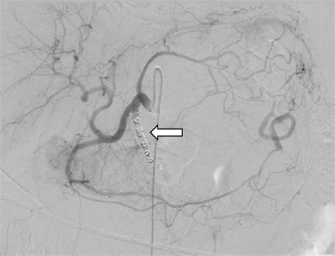 Postembolization Angiography Without Contrast Fluid In The Splenic