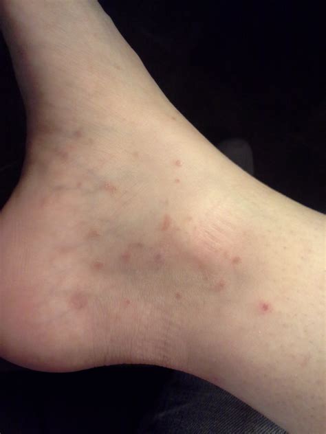 Peds Rash On Bottom Of Feet