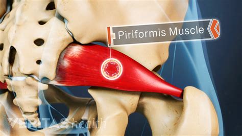 What Is Piriformis Syndrome Spine Health